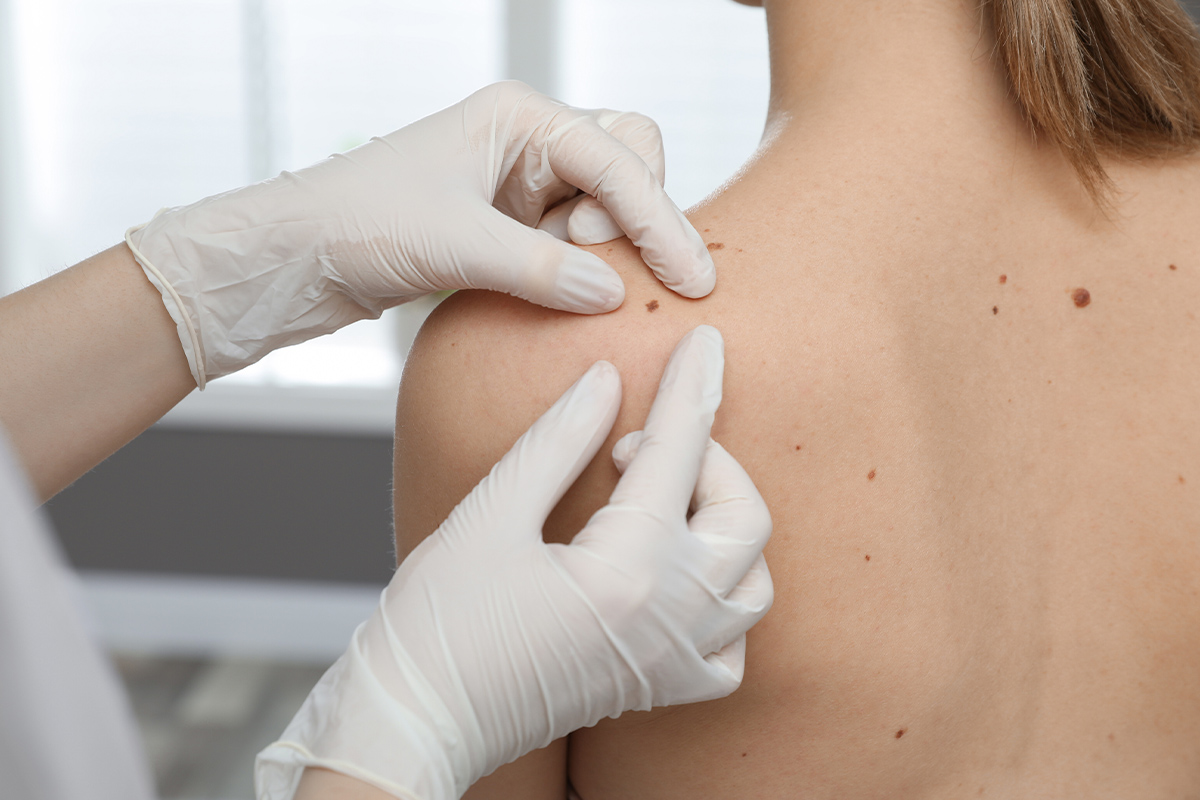 Doctor preparing patient for skin cancer surgery in Sarasota.