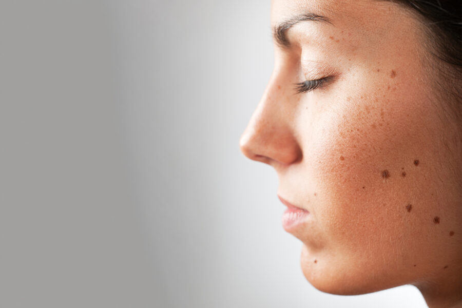 Surgical Excision - Paradise Dermatology